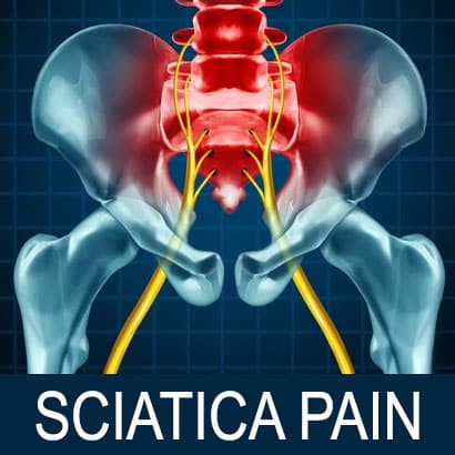 3d model of human pelvis and sciatica nerve pain